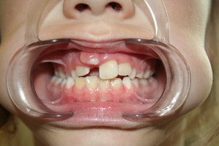 Osteopathie en haar betekenis voor gezicht en -mondholte ontwikkeling en voor de functionele kaakgewrichtsorthopedie en orthodontie bij kinderen met Philip van Caille DO